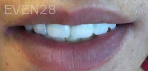 Arsany-Labib-Dentures-After-1