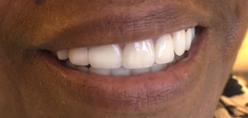 Arsany-Labib-Dentures-After-2