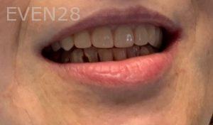 Arsany-Labib-Dentures-After-3