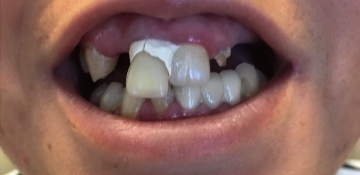 Arsany-Labib-Dentures-Before-1