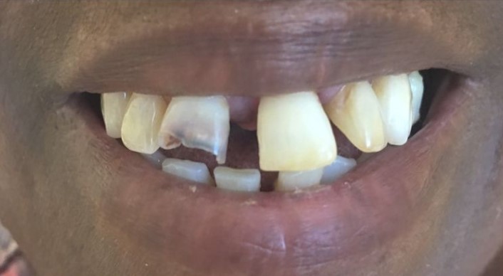 Arsany-Labib-Dentures-Before-2