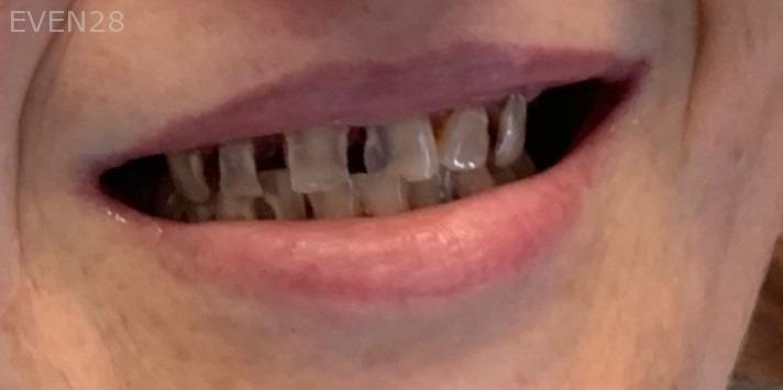 Arsany-Labib-Dentures-Before-3