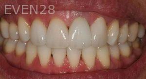 Claire-Cho-Porcelain-Veneers-After-1