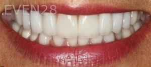 Claire-Cho-Porcelain-Veneers-After-11