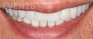 Claire-Cho-Porcelain-Veneers-After-12