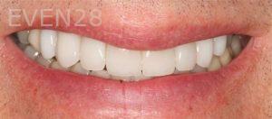 Claire-Cho-Porcelain-Veneers-After-14