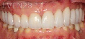 Claire-Cho-Porcelain-Veneers-After-15