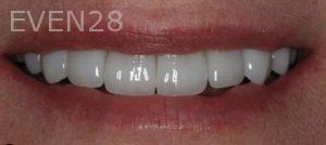 Claire-Cho-Porcelain-Veneers-After-16