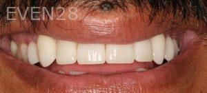 Claire-Cho-Porcelain-Veneers-After-17