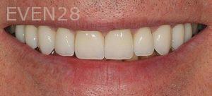 Claire-Cho-Porcelain-Veneers-After-18