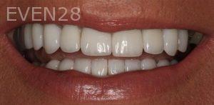 Claire-Cho-Porcelain-Veneers-After-19