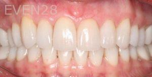 Claire-Cho-Porcelain-Veneers-After-2