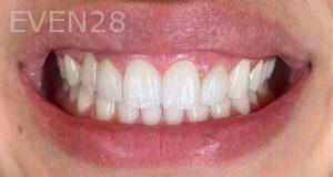 Claire-Cho-Porcelain-Veneers-After-20
