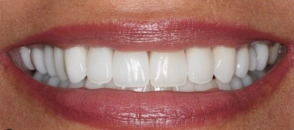 Claire-Cho-Porcelain-Veneers-After-21