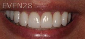 Claire-Cho-Porcelain-Veneers-After-22