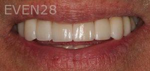 Claire-Cho-Porcelain-Veneers-After-23