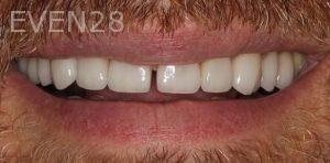 Claire-Cho-Porcelain-Veneers-After-24