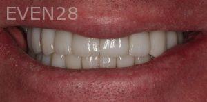 Claire-Cho-Porcelain-Veneers-After-26