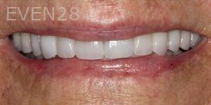 Claire-Cho-Porcelain-Veneers-After-27