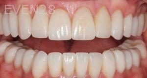 Claire-Cho-Porcelain-Veneers-After-28