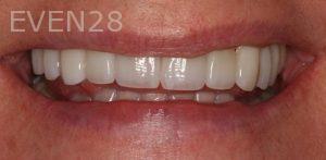 Claire-Cho-Porcelain-Veneers-After-29