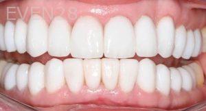 Claire-Cho-Porcelain-Veneers-After-3