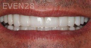 Claire-Cho-Porcelain-Veneers-After-30