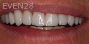 Claire-Cho-Porcelain-Veneers-After-31