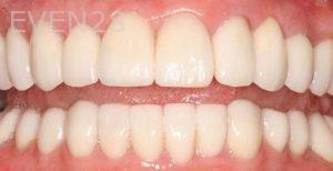 Claire-Cho-Porcelain-Veneers-After-4