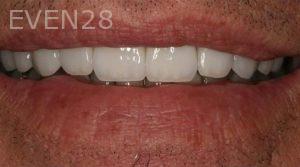 Claire-Cho-Porcelain-Veneers-After-5