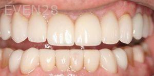 Claire-Cho-Porcelain-Veneers-After-6