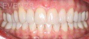 Claire-Cho-Porcelain-Veneers-After-8