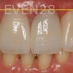 Claire-Cho-Porcelain-Veneers-After-9