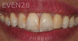 Claire-Cho-Porcelain-Veneers-Before-1