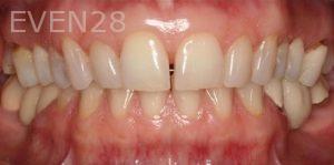 Claire-Cho-Porcelain-Veneers-Before-10