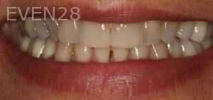Claire-Cho-Porcelain-Veneers-Before-11