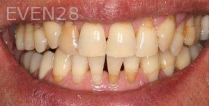 Claire-Cho-Porcelain-Veneers-Before-12