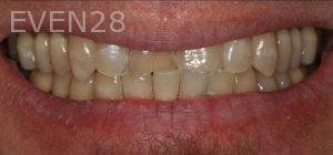Claire-Cho-Porcelain-Veneers-Before-13
