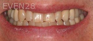 Claire-Cho-Porcelain-Veneers-Before-14