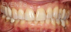 Claire-Cho-Porcelain-Veneers-Before-15