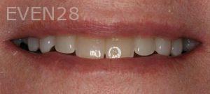 Claire-Cho-Porcelain-Veneers-Before-16