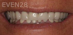 Claire-Cho-Porcelain-Veneers-Before-19