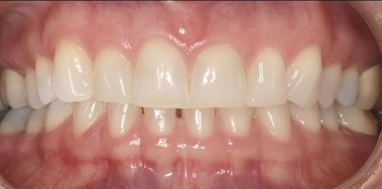 Claire-Cho-Porcelain-Veneers-Before-2
