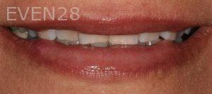 Claire-Cho-Porcelain-Veneers-Before-21
