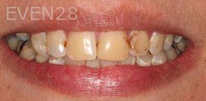 Claire-Cho-Porcelain-Veneers-Before-22