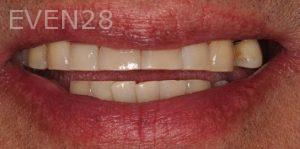 Claire-Cho-Porcelain-Veneers-Before-23