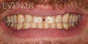 Claire-Cho-Porcelain-Veneers-Before-24