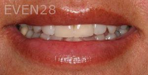 Claire-Cho-Porcelain-Veneers-Before-25