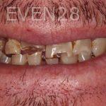 Claire-Cho-Porcelain-Veneers-Before-26