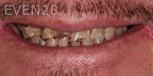 Claire-Cho-Porcelain-Veneers-Before-26